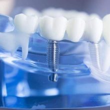 מה צריך לדעת לפני טיפול שתלים בשיניים?