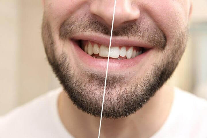 איך להלבין את השיניים שלכם?