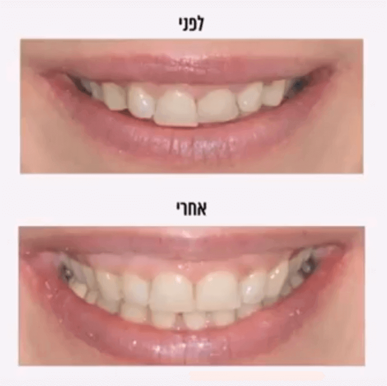 יישור שיניים לפני ואחרי הטיפול