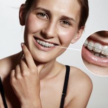 באיזה גיל מתחילים יישור שיניים?