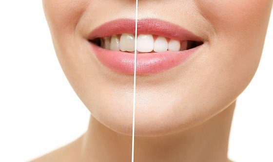 כל מה שצריך לדעת על הלבנת שיניים