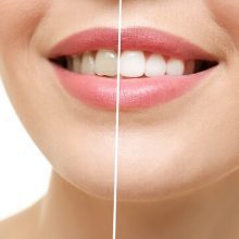 כמה עולה הלבנת שיניים?