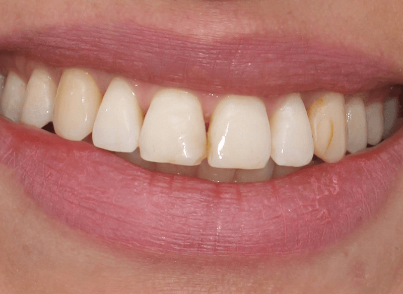 לפני ציפוי שיניים במרפאת ד