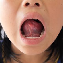 פצעים בפה אצל ילדים - למה הם מופיעים ואיך מטפלים