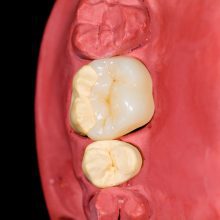 שחזור שיניים אסתטי - כל מה שצריך לדעת על סתימות לבנות ומילואות חרסינה לשיקום החיוך שחזור שיניים אסתטי - כל מה שצריך לדעת על סתימות לבנות ומילואות חרסינה לשיקום החיוך