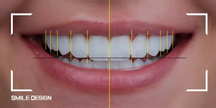 עיצוב חיוך דיגיטלי (DSD): איך מתכננים את החיוך החדש עוד לפני הטיפול?